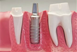 dental-implant-fixation-post