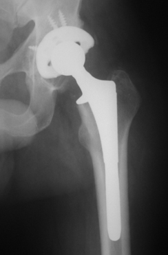 hip-replacement-implant-anchored-in-femur