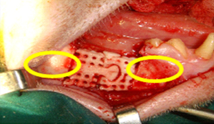 modular-trs-mandibular-implant-with-press-fit-fixation-shown-in-yellow